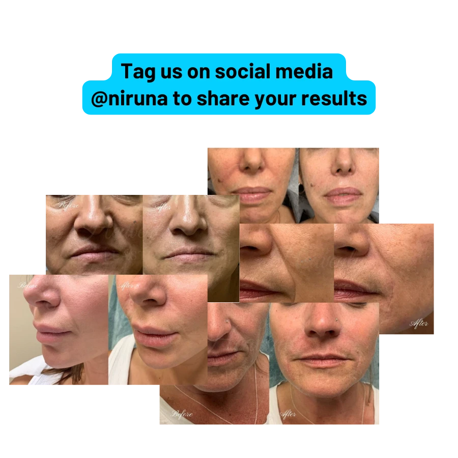 Microcrystalline Laugh Line Lifting Masks